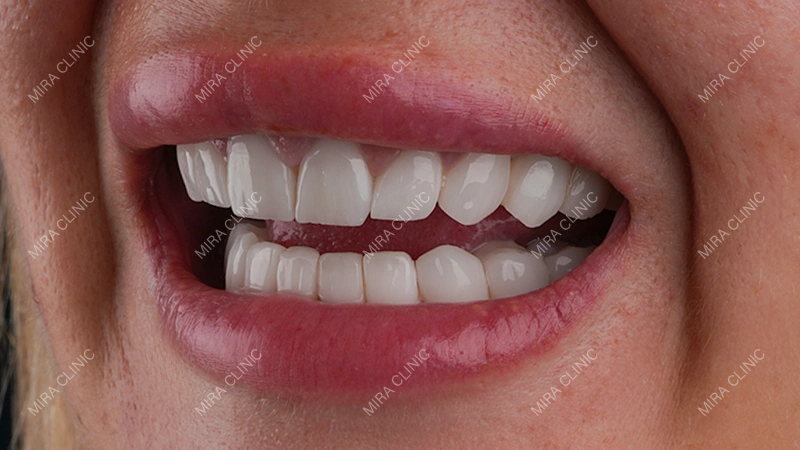 Hollywood Smile in Turkey